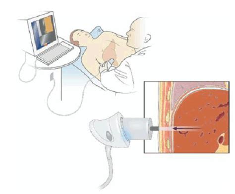 Diagnosis of cirrhosis by transient elastography (FibroScan): a .